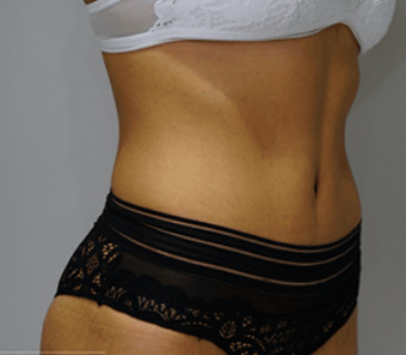 Liposuccion du ventre, Liposuccion abdominale