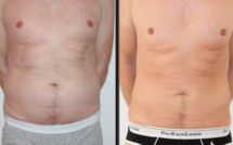 Abdominplastie ou plastie abdominale ? Un spécialiste à Genève en Suisse